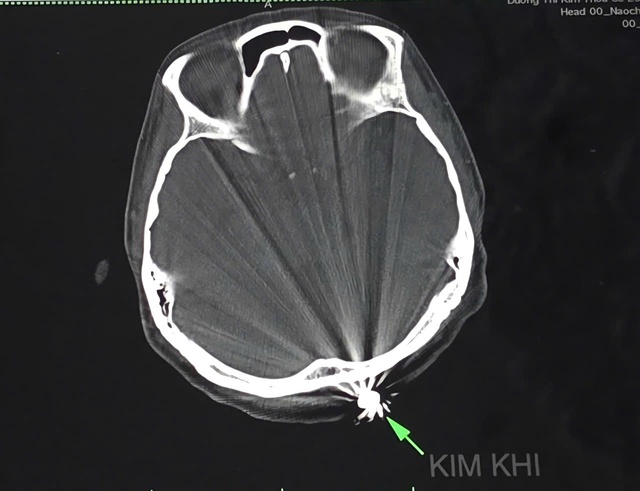 Vietnamese woman survives stray bullet to head while gardening- Ảnh 1.