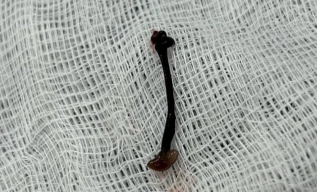 Leech found living in nose of 30-month-old Vietnamese boy- Ảnh 2.