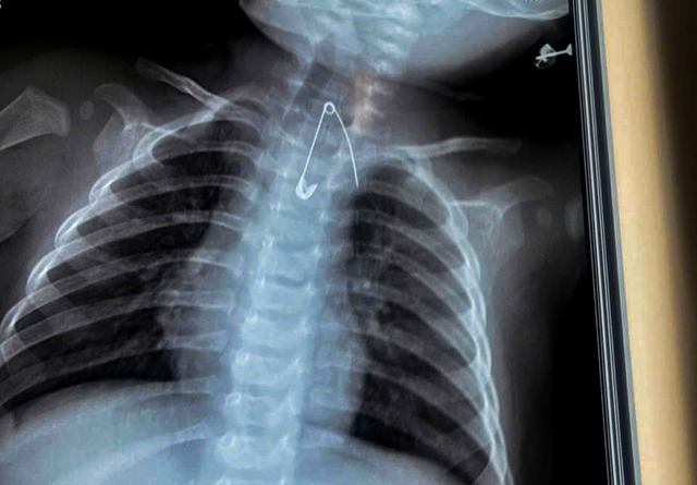 Vietnam hospital saves 2 children who swallowed safety pin, lollipop stick - Ảnh 2.