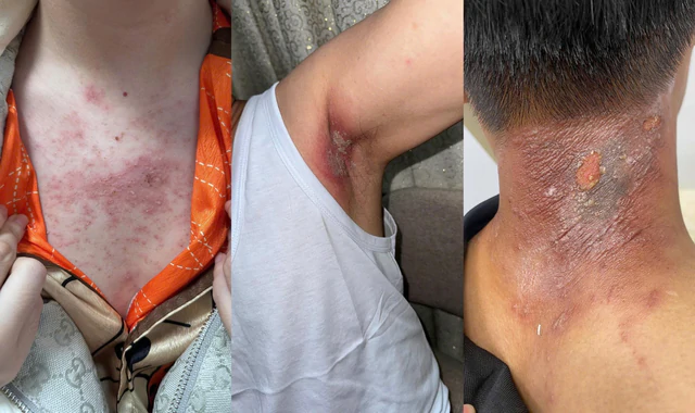 Ever had a burn-like rash appear overnight? These rove beetles in Vietnam may be to blame - Ảnh 4.