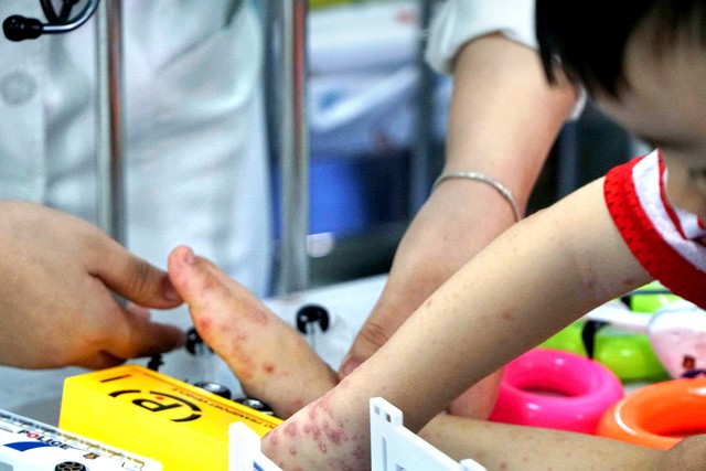 Ho Chi Minh City records over 42,000 hand, foot, mouth disease cases- Ảnh 1.