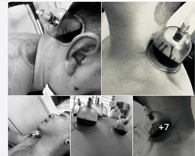 Social media trend of pricking, wet cupping to prevent strokes raises concern in Vietnam- Ảnh 1.