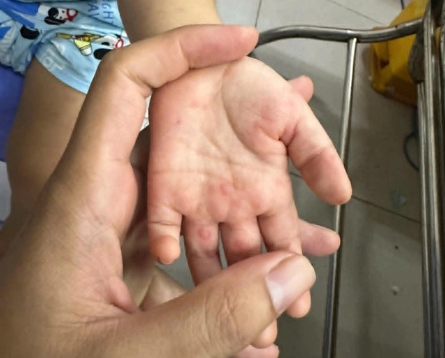 Delayed transfers, healthcare gaps, EV71 drive rise in child HFMD deaths in southern Vietnam- Ảnh 1.