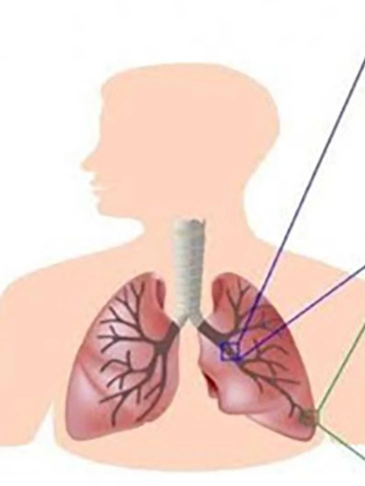 Khó thở, ho dai dẳng: Dấu hiệu sớm của bệnh gây tử vong  thứ ba thế giới - Ảnh 1.