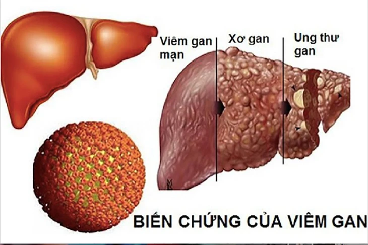 Bác sĩ cảnh báo bệnh viêm gan lây qua đường tiêu hóa, quan hệ tình dục ít người biết tới - Ảnh 2.