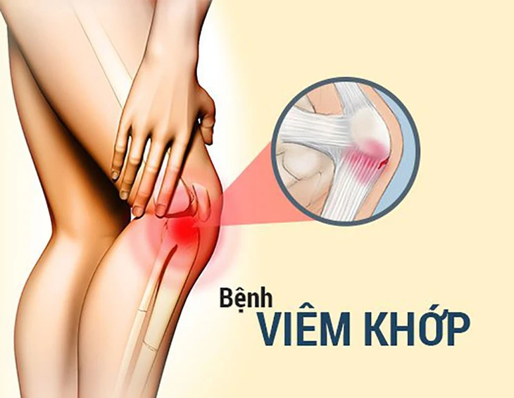 Viêm khớp gối, chỉ cần nghỉ ngơi hay chích thuốc vô khớp?