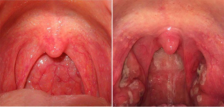 Đừng chủ quản với triệu chứng đau cổ, khó nuốt - Ảnh 2.