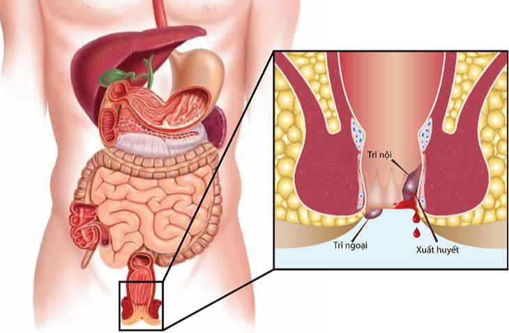 Đi cầu có máu, có phải bệnh trĩ?