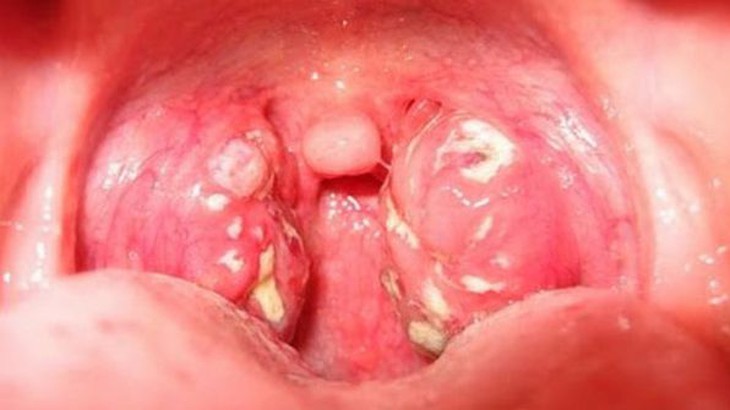 Thường bị sốt nổi hạch hàm, tiêu chảy, liệu có dính HIV?