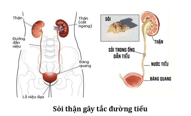 Những biến chứng nguy hiểm của bệnh sỏi thận, bạn có biết? - Ảnh 2.