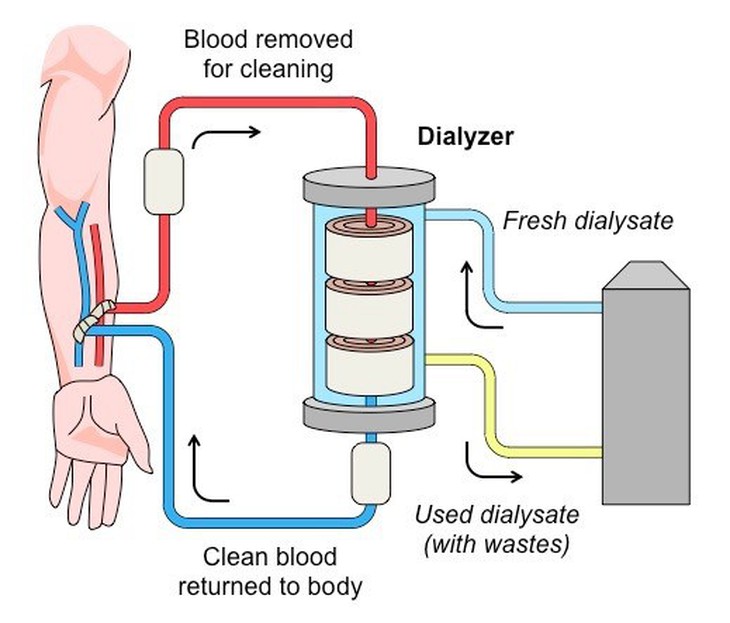 Lọc máu liên tục cứu sống bé trai bị tay chân miệng - Ảnh 1.