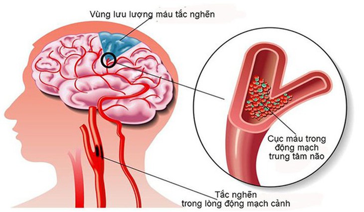 Hoạt huyết dưỡng não: Không nên ngộ nhận - Ảnh 1.