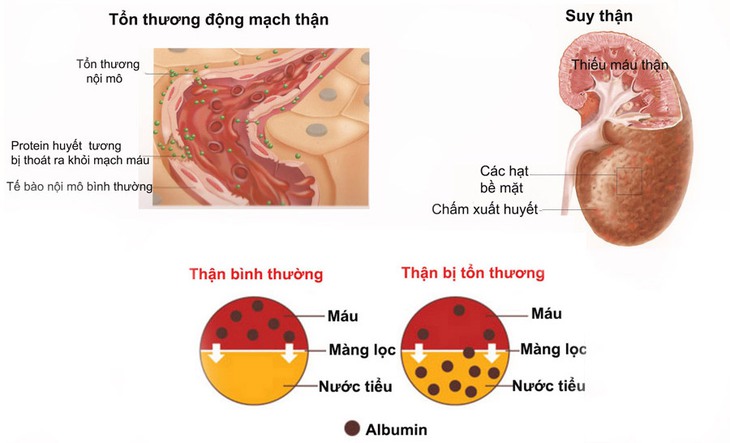 Những biến chứng nguy hiểm của bệnh sỏi thận, bạn có biết? - Ảnh 1.