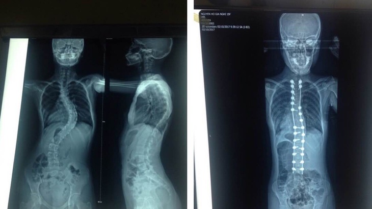 Sản phụ người Campuchia thoát cửa tử ngoạn mục do mắc hội chứng MarFan hiếm gặp - Ảnh 1.