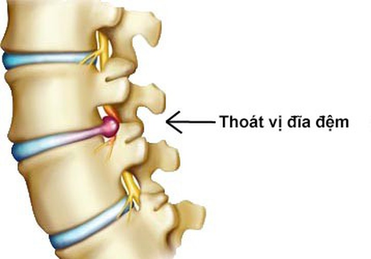 Thoái hóa cột sống sau 40 năm nằm võng - Ảnh 1. Thoái hóa cột sống sau 40 năm nằm võng - Ảnh 1.