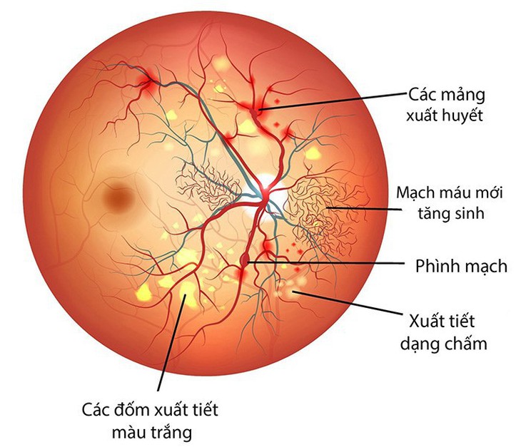 Bệnh võng mạc đái tháo đường - nguyên nhân chính gây mù lòa - Ảnh 1.