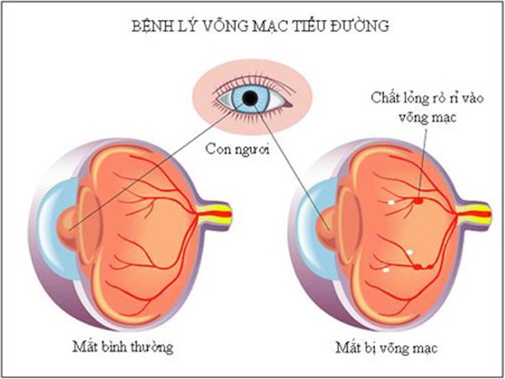 Các bệnh võng mạc thường gặp - Ảnh 1.