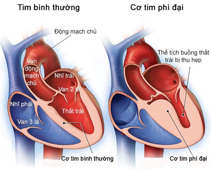 Thế nào là bệnh cơ tim phì đại - Ảnh 1.