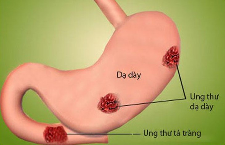 Ung thư dạ dày có thể chữa khỏi nếu được phát hiện sớm - Ảnh 1.