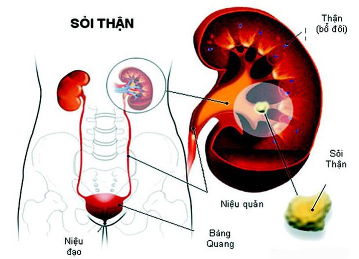 Biến chứng sỏi thận - Ảnh 1.