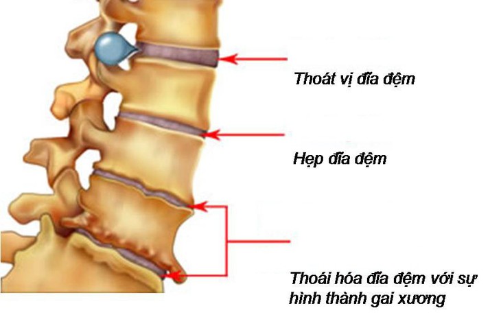 Thoái hóa cột sống ở người già và cách chữa - Ảnh 1.