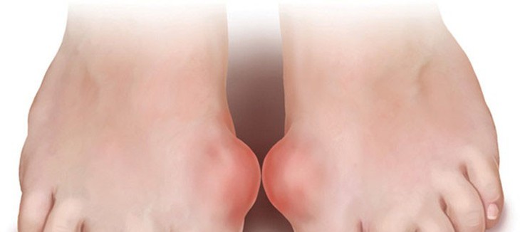 Bệnh gout và cách hạn chế bệnh gout - Ảnh 1.