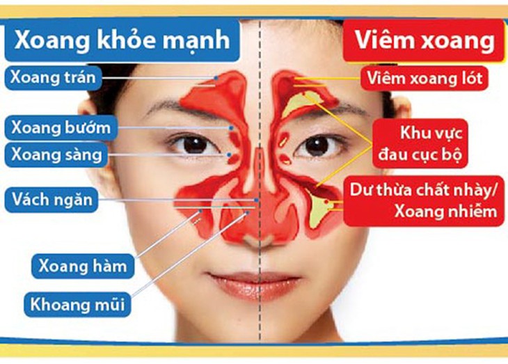 Viêm xoang cấp ở người lớn và cách phòng ngừa - Ảnh 1.