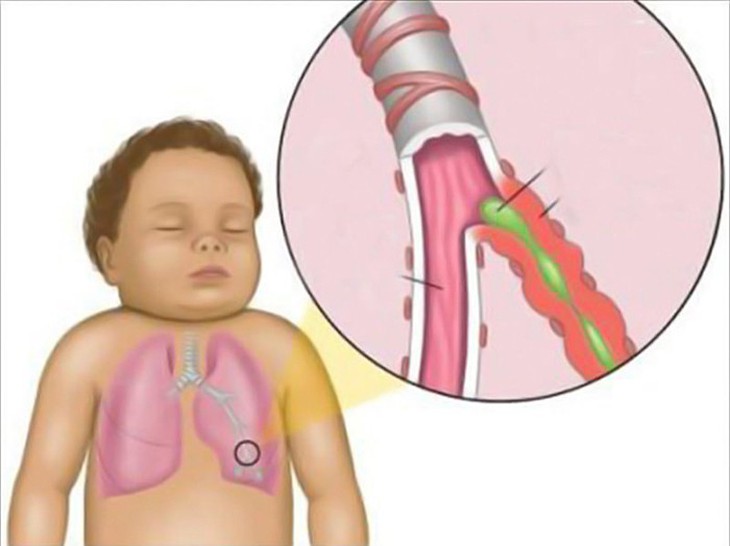 Đếm nhịp thở giúp mẹ phát hiện kịp thời bệnh viêm phổi ở trẻ - Ảnh 2. Đếm nhịp thở giúp mẹ phát hiện kịp thời bệnh viêm phổi ở trẻ - Ảnh 2.