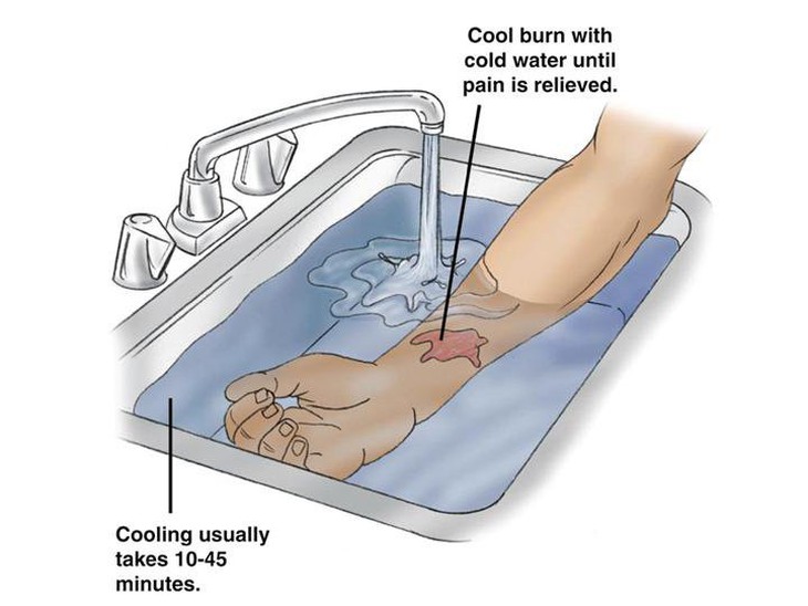 Làm gì khi trẻ bị bỏng? - Ảnh 1.