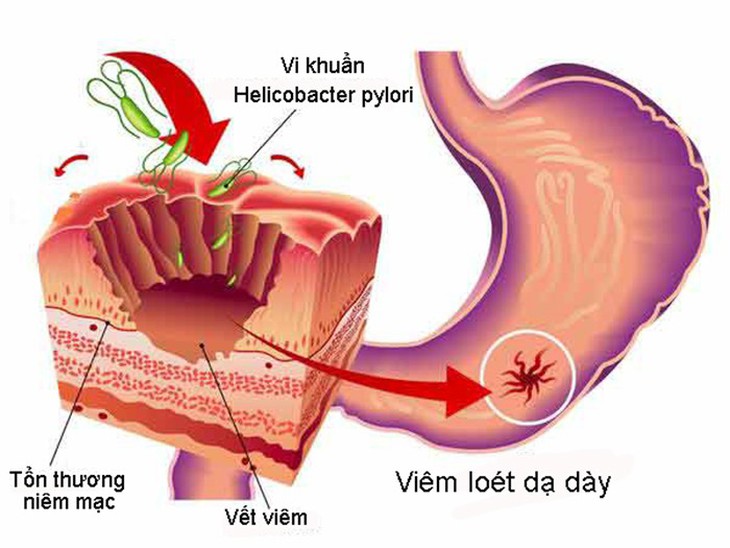 Vi khuẩn Helicobacter pylori gây loét dạ dày - Ảnh 1.