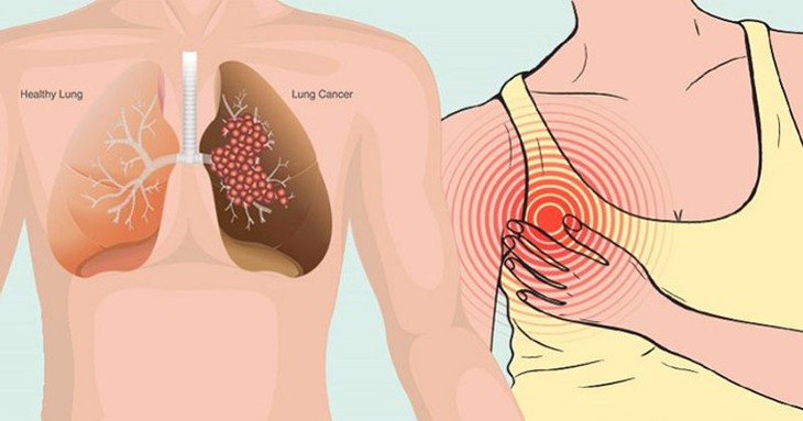 10 dấu hiệu cảnh báo sớm bệnh ung thư phổi - Ảnh 1.