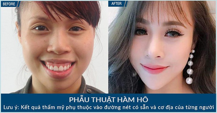 Hô, móm phải phẫu thuật hàm hay chỉ niềng răng? - Ảnh 1.