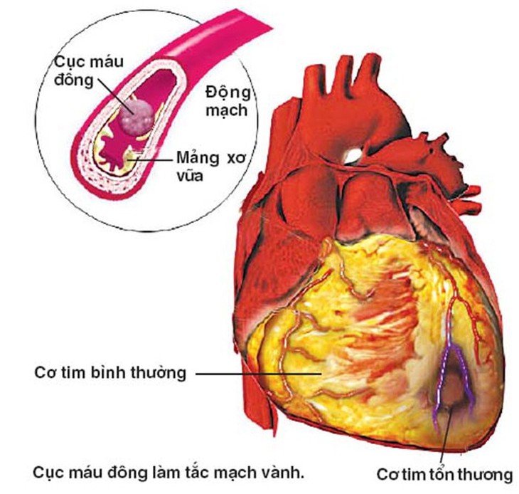 Cảnh giác đột quỵ não do tim khi giao mùa - Ảnh 1.