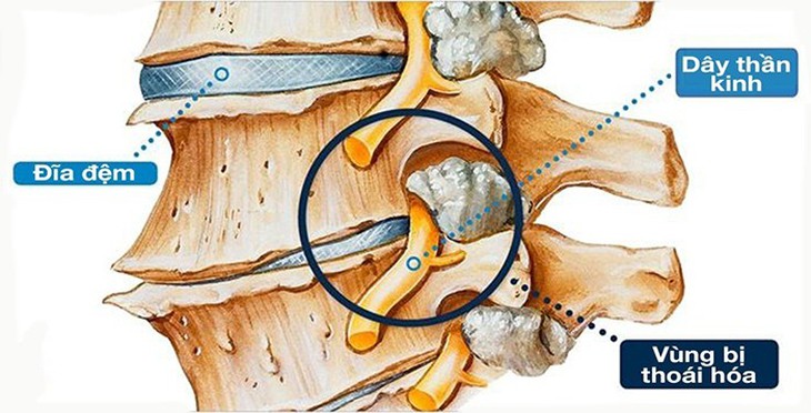 Thoái hóa cột sống - nguồn cơn gây ra các bệnh xương khớp - Ảnh 1.