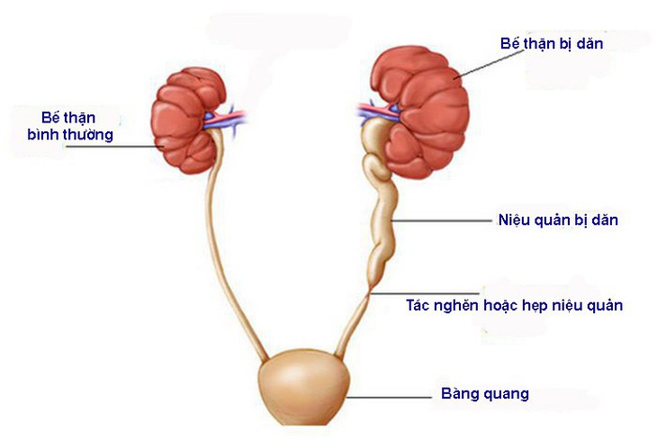 Những giải pháp tích cực khi bị thận ứ nước - Ảnh 1.