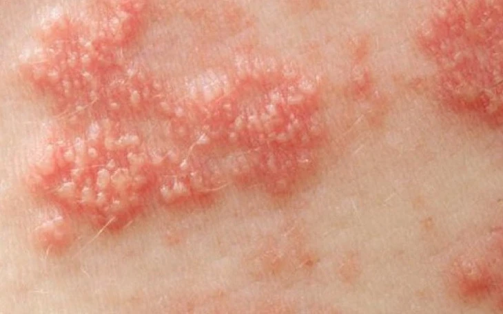 Tăng ca biến chứng viêm não do zona thần kinh, có bệnh nhân  - Ảnh 2.