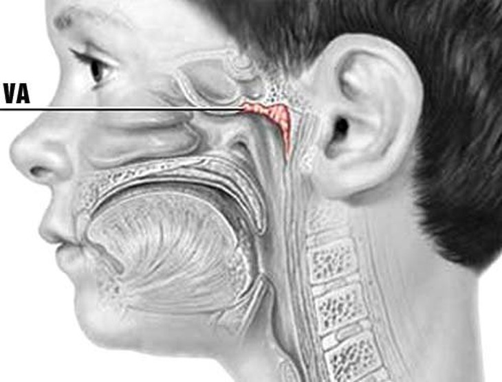 Bệnh dị ứng, hen phế quản ngày càng nhiều ở người già, trẻ em - Ảnh 1.