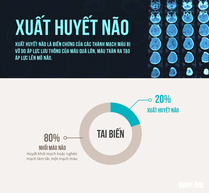 Xuất huyết não khởi điểm từ đâu? - Ảnh 1.