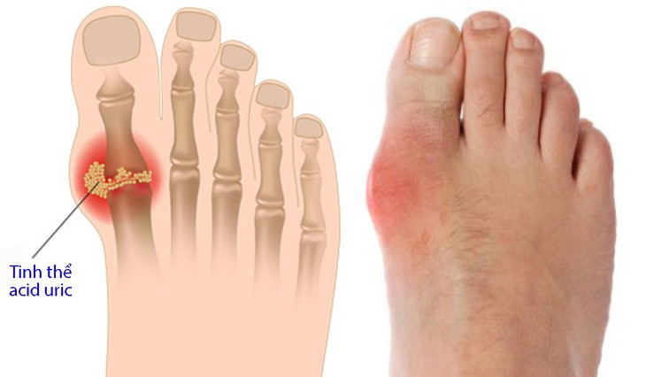 Cách phòng chống bệnh gout - Ảnh 1.