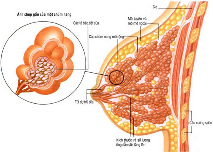 Bướu ở ngực, chưa chắc là ung thư - Ảnh 1.