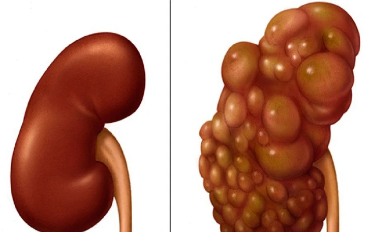 Người có 'nang thận' ngày càng tăng: Bệnh lành tính hay dấu hiệu ung thư thận tiềm ẩn? - Ảnh 3.