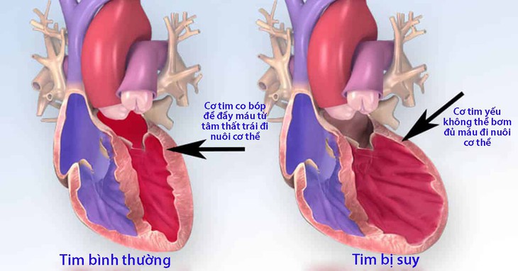 Những cách để phòng tránh suy tim - Ảnh 1.