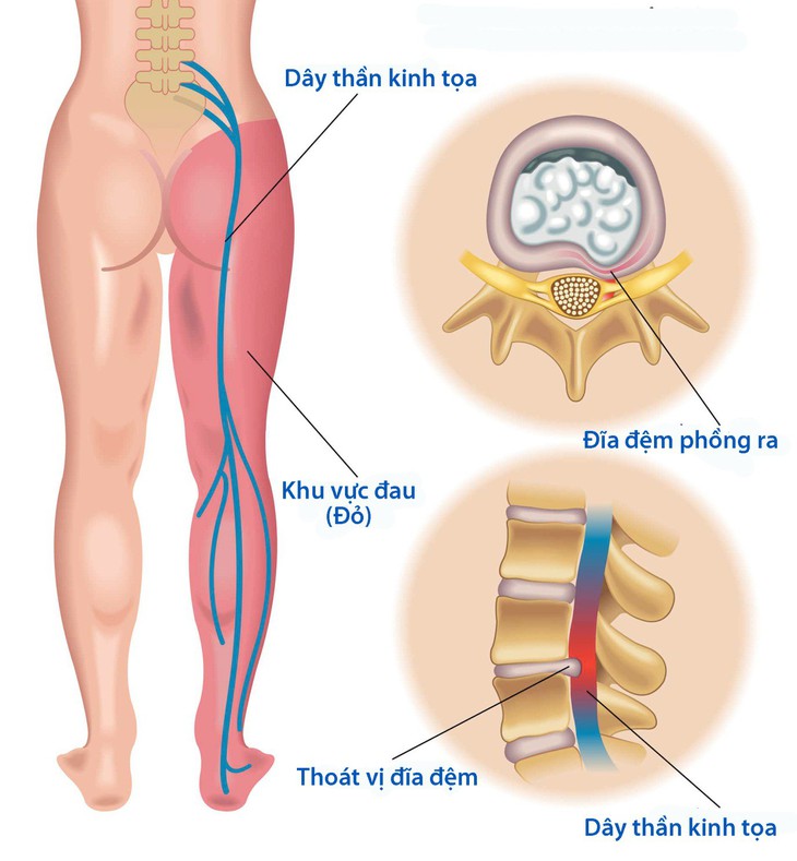 Đau thần kinh tọa - Ảnh 1.