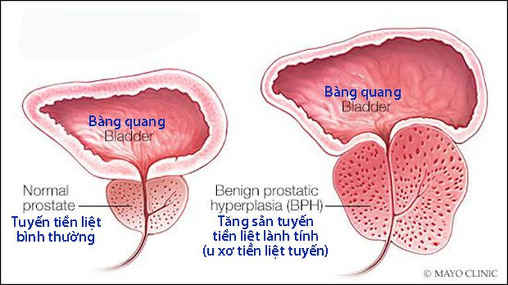 Những triệu chứng u xơ tiền liệt tuyến thường gặp - Ảnh 1.