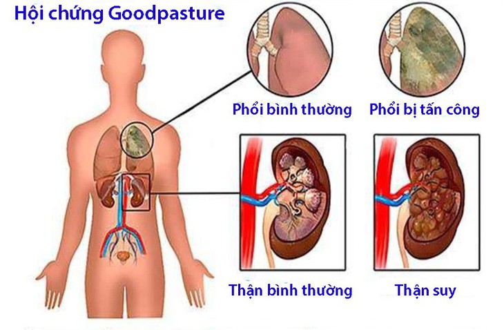 Hội chứng Goodpasture - Ảnh 1.