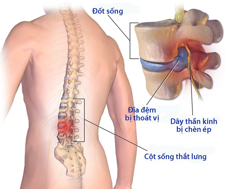 Điều trị thoát vị đĩa đệm - Ảnh 1.