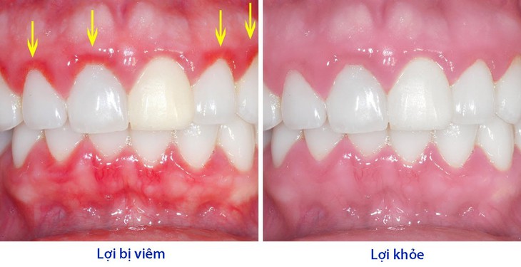 Nguyên nhân gây bệnh viêm lợi và cách điều trị - Ảnh 1.