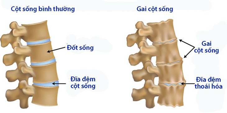 Nguyên tắc dinh dưỡng của bệnh gai cột sống - Ảnh 1.