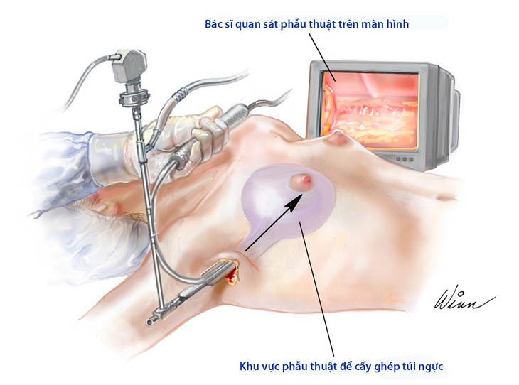 Phẫu thuật nâng ngực - Ảnh 1.