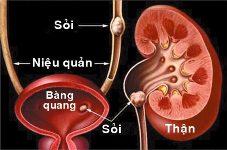 Sỏi đường tiểu - Ảnh 1.